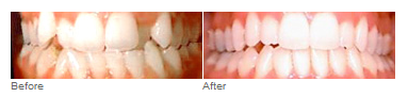 Invisalign Clear Braces, Spring, The Woodlands, NW Houston, TX