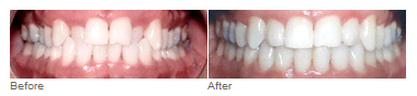 invisalign, Clear Braces, NW Houston, Spring, The Woodlands, TX