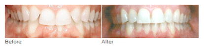 Invisalign, Clear Braces, Invisible braces, Spring, NW Houston, The Woodlands, TX